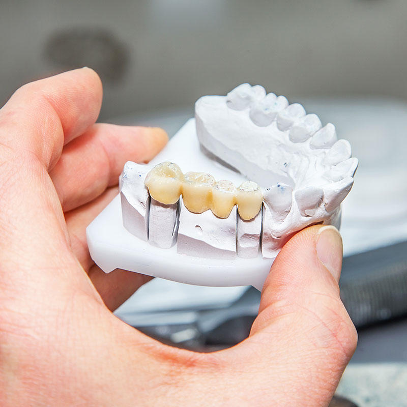 dental bridge being held