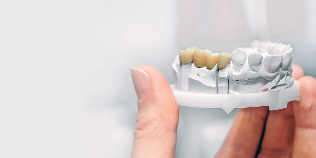 dental bridge while crafting