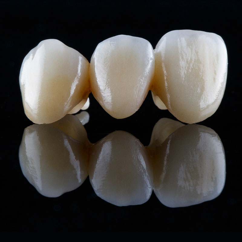 dental bridge close up