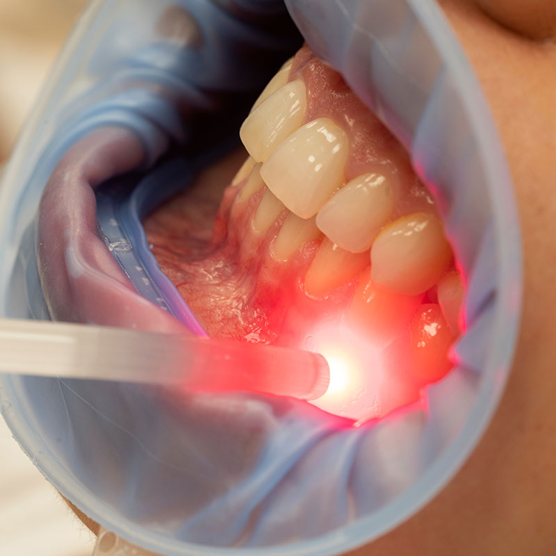 dental laser hitting spot on gum