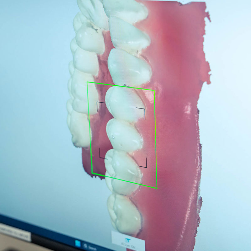 guided dental implant scan