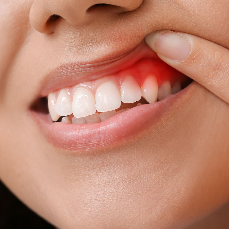 gum disease example