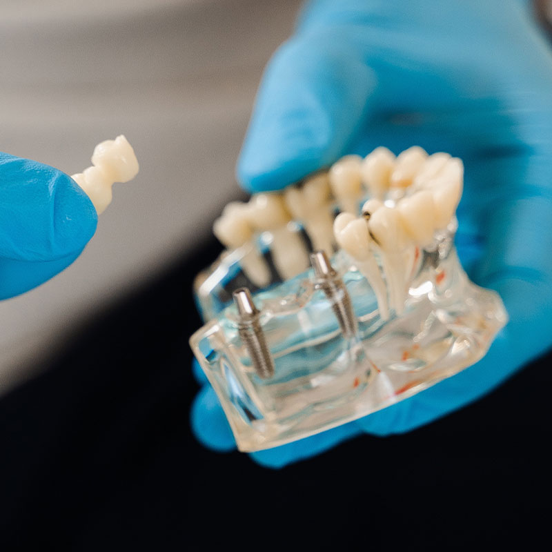 implant bridge being held