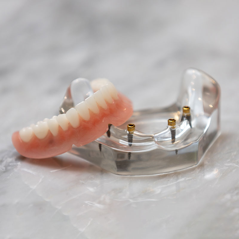 implant denture on counter