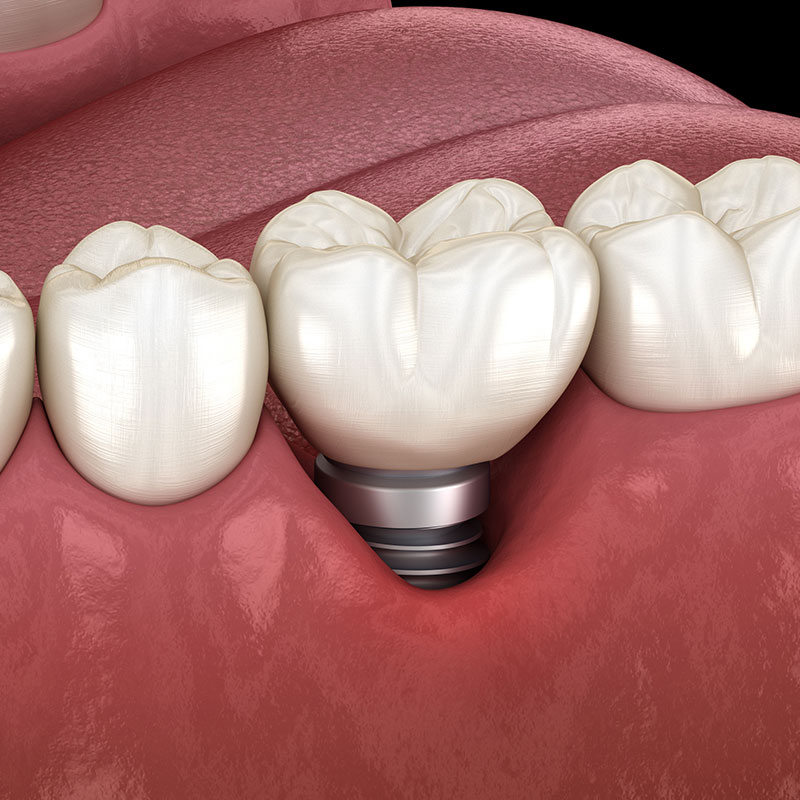 implant failure symptoms