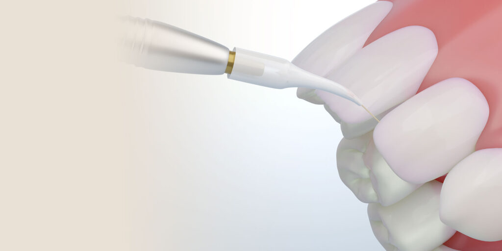3d laser blasting bacertia