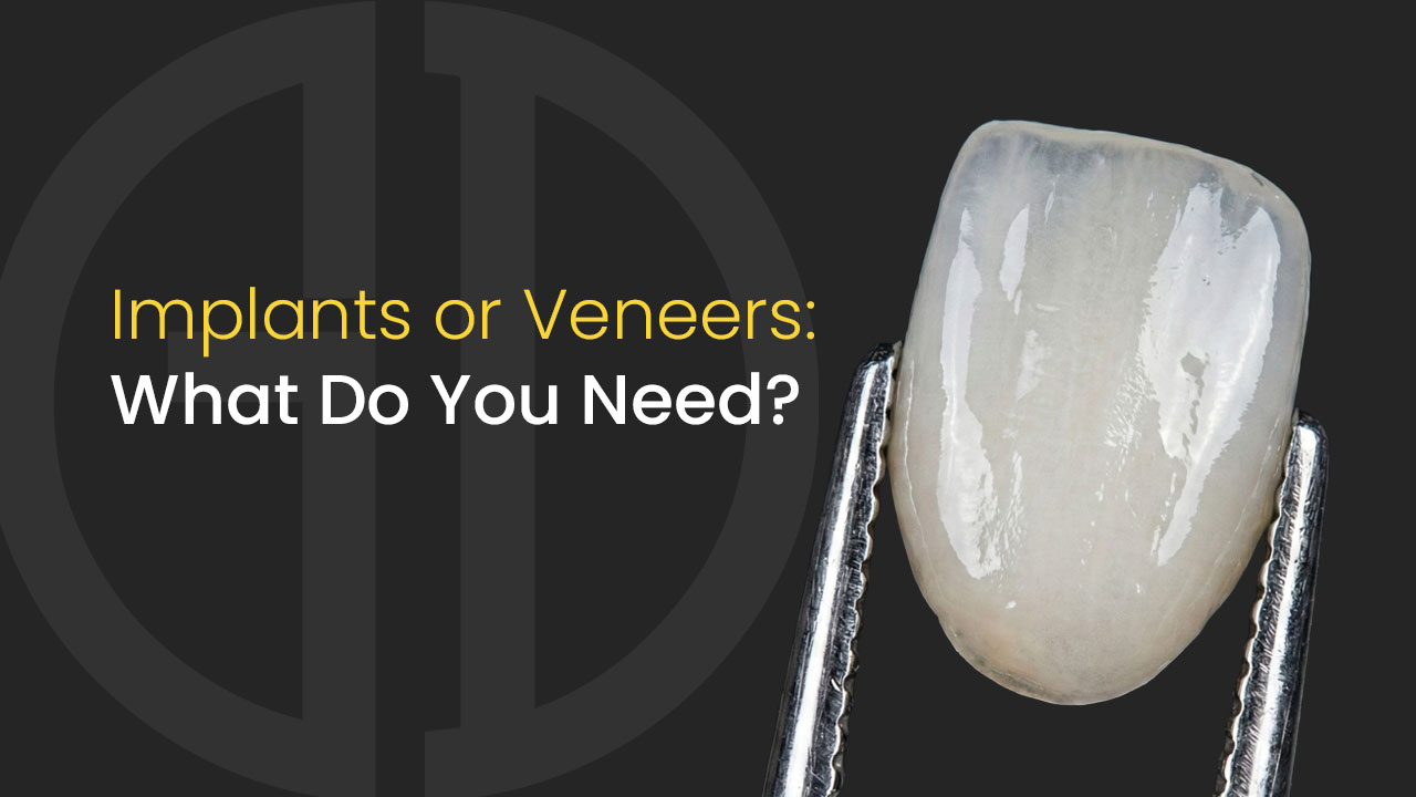 mv 2 veneers vs implants
