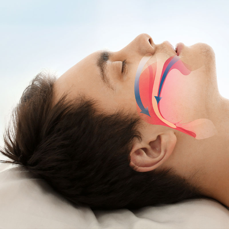 restricted airway sleep apnea