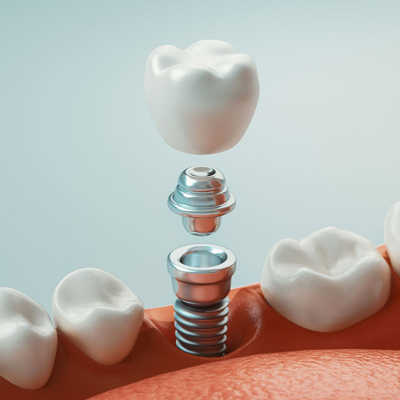 single dental implant