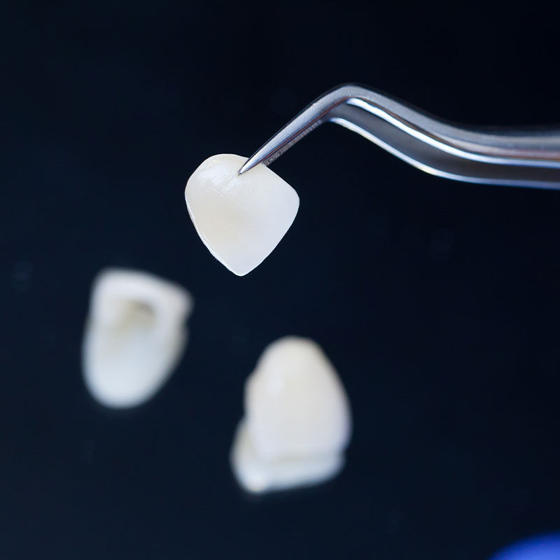close up of dental veneer