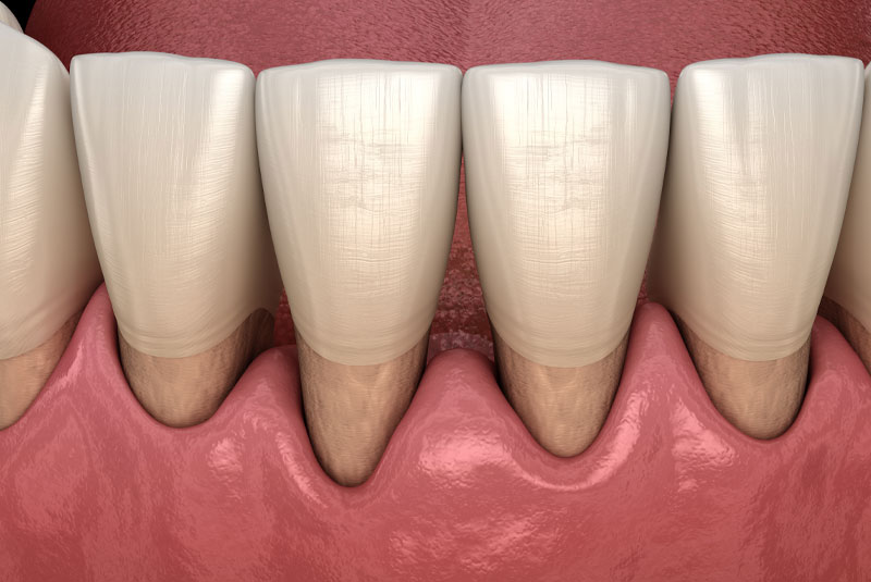dental gum recession graphic